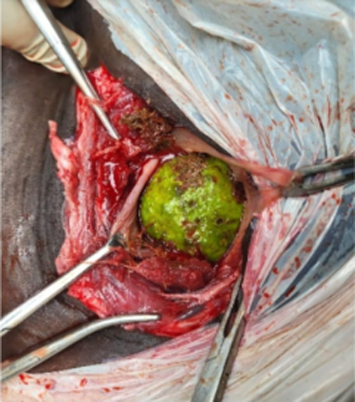 MIRACLE ON THE OPERATING FIELD: Surgical Resolution of Esophageal Obstruction by Guava (peyara) through Life Saving Surgery