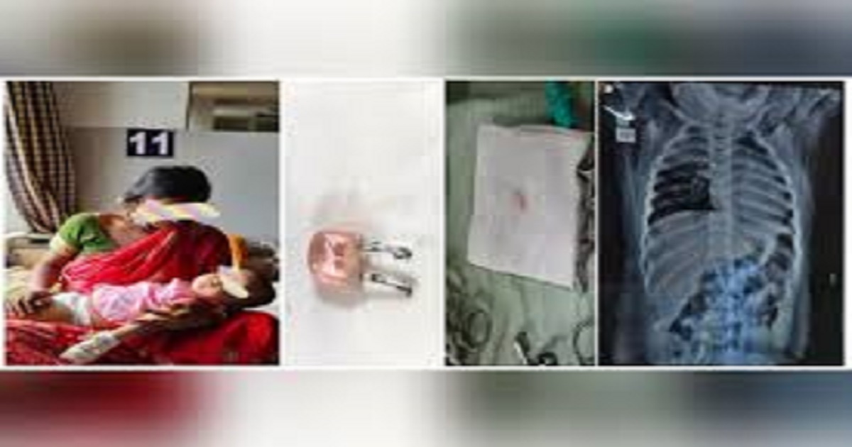 Infant saved after complex bronchoscopy removes LED bulb at GB Pant Hospital